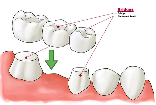 Dental Bridges-Cosmetic Dentistry Le Sueur, MN- Le Sueur Family Dental