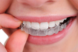 Dental Mouth Guard- Dental Night Guard Le Sueur-Le Sueur Family Dental