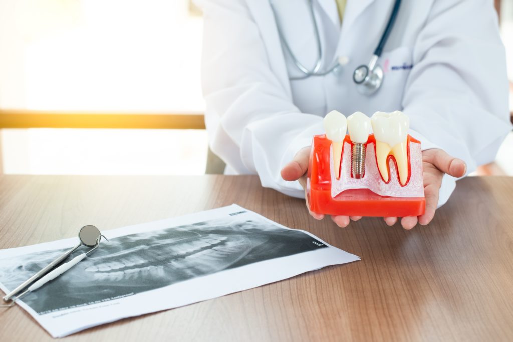 Why You should consider dental implants - LSFD