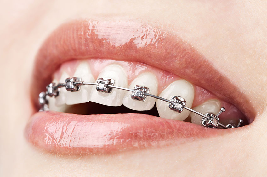 Fastbraces® Technology- Dentist Near me | Le Sueur Family Dental, MN