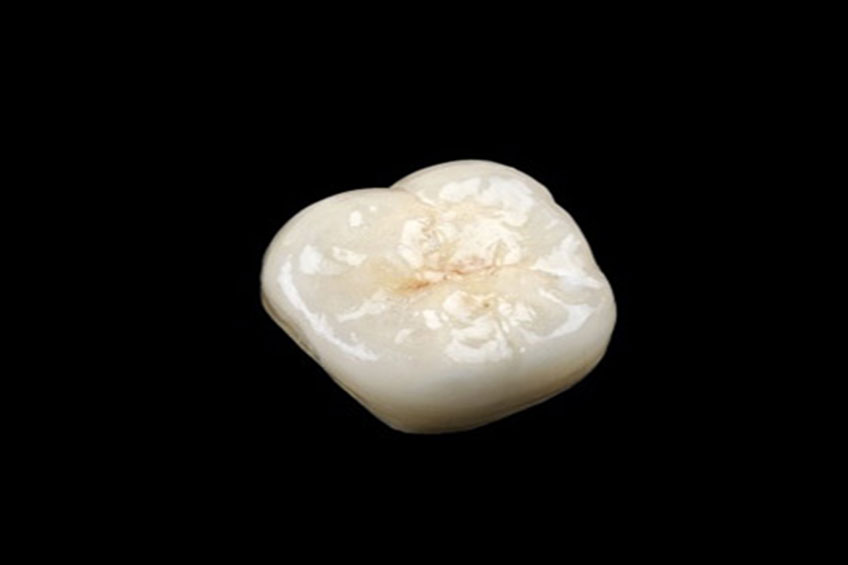 Dental Crowns Le Sueur,MN | Porcelain Crowns | LeSueur Family Dental