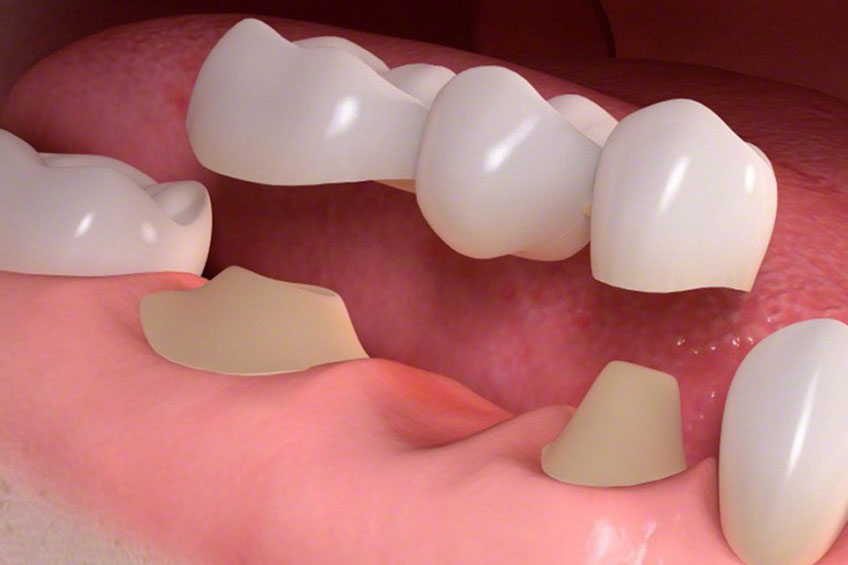 dental bridges