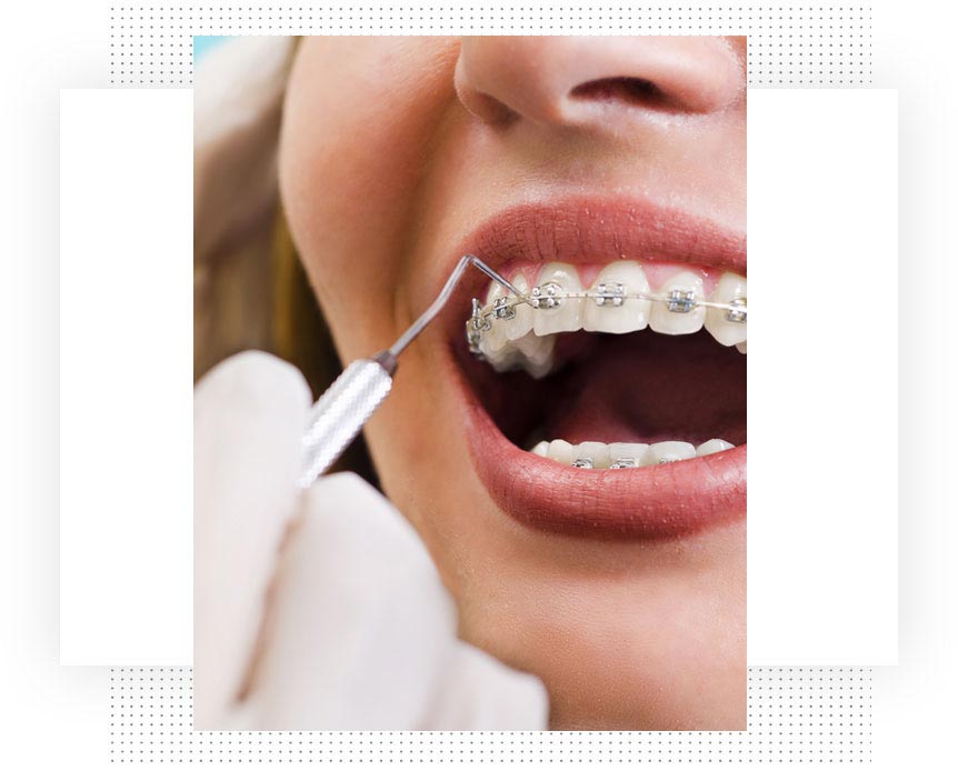 Braces Near Me – Points to Keep in Mind
