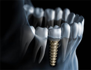 Dental Implants