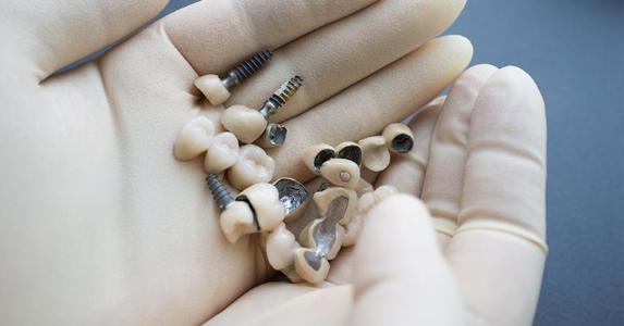 Best Dental Implants | best Dentistry in Minnesota | Lesueurfamilydental