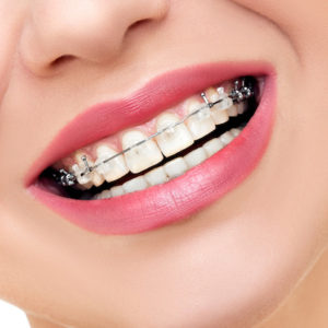 dental braces