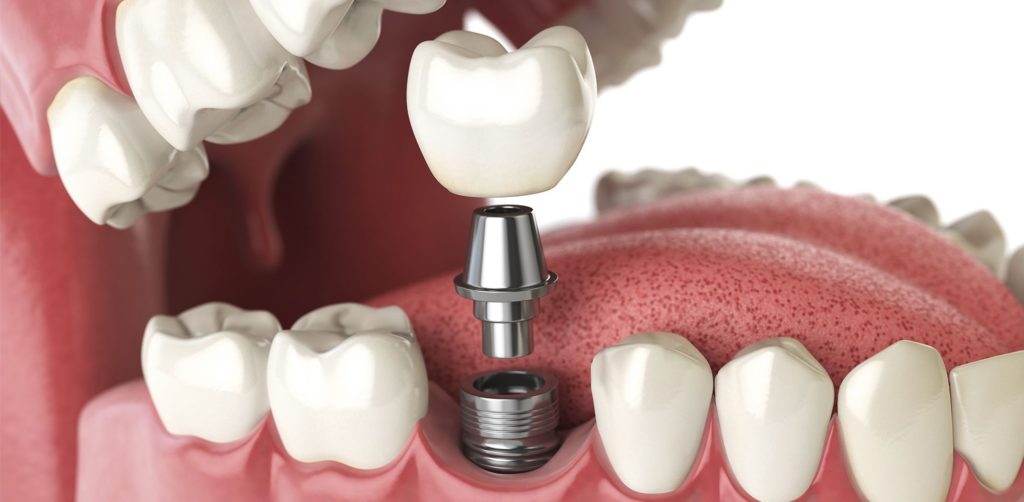 dental implants basics