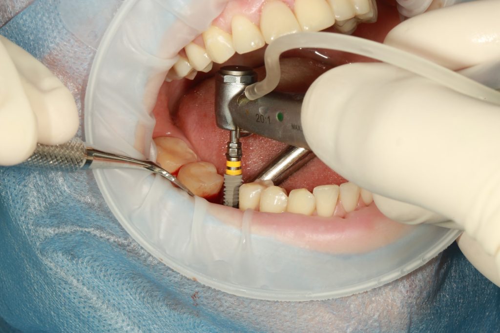 dentla implants 4