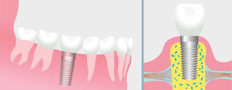 Dental Implants