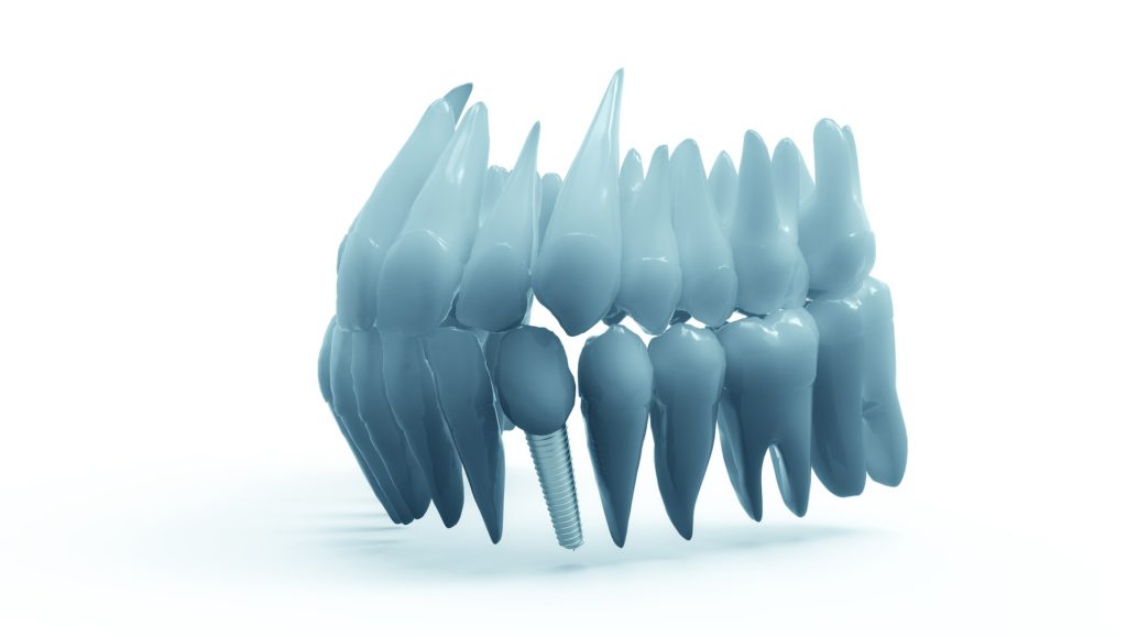 dental implants