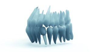 dental implants