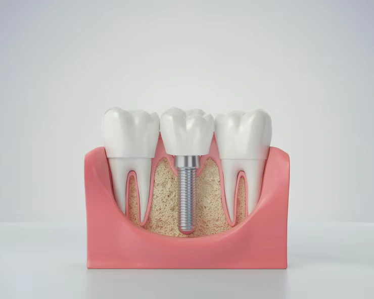 how to care for dental implants