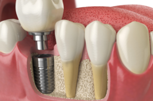 Dental Implants Necessary