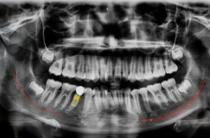 dental xray