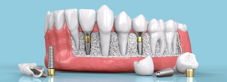 dental implants