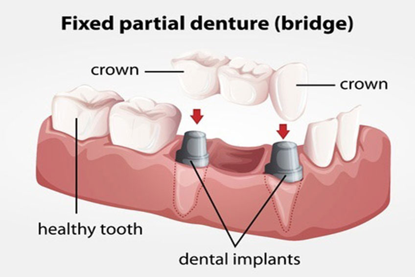 Porcelain Fixed Bridges