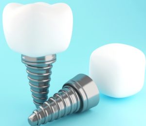 Dental Implants