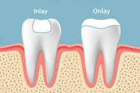 Inlays Onlays Le Sueur Family Dental