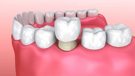 Porcelain Crowns Le Sueur Family Dental