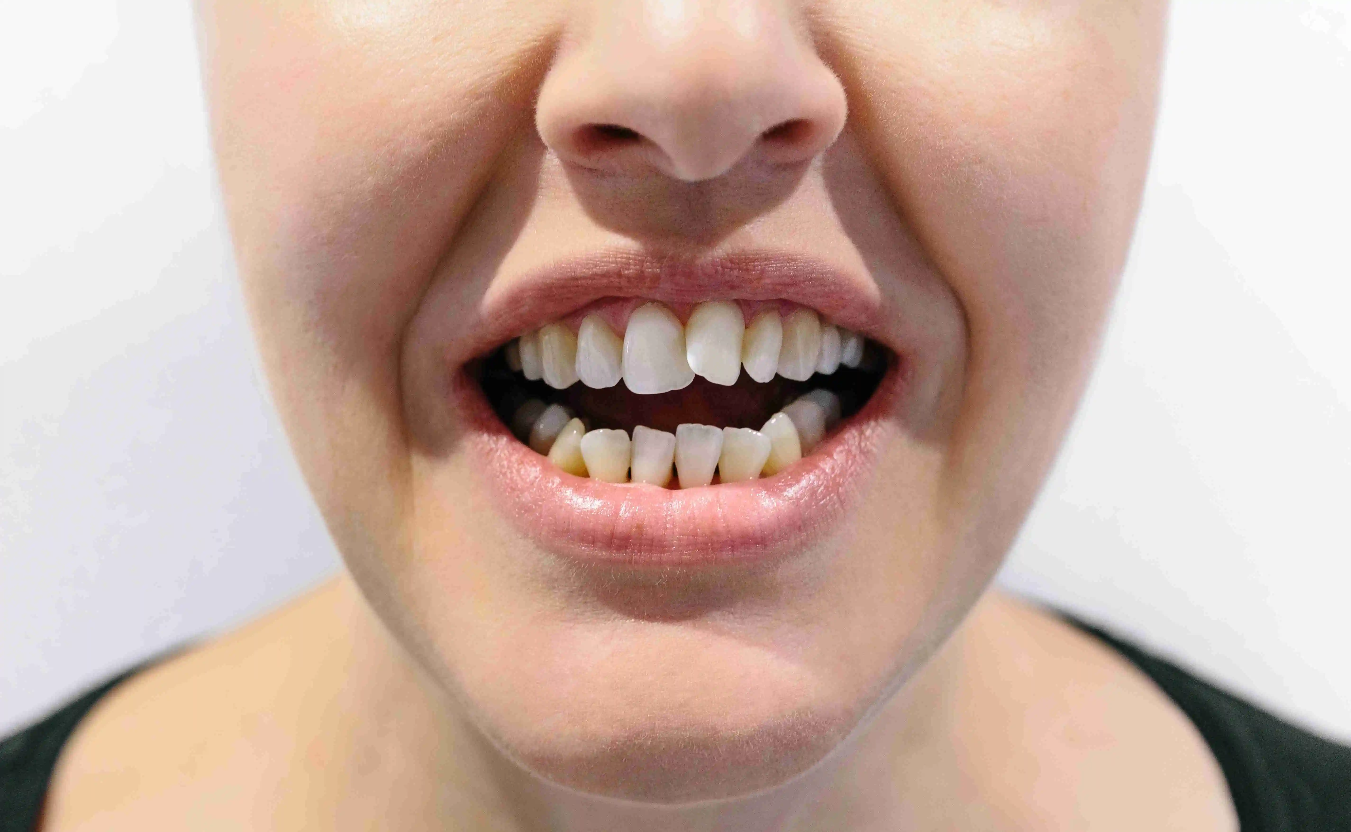 Cosmetic Dental Bonding on Teeth