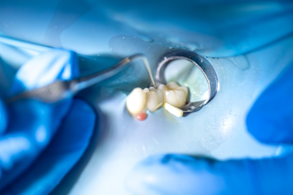 restore dental