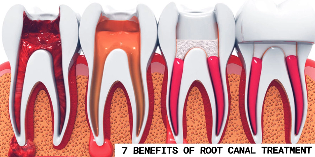 7 Benefits of Root Canal Treatment