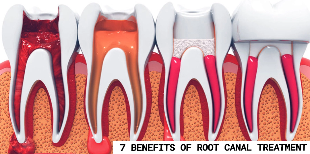 7 benefits of root canal treatment