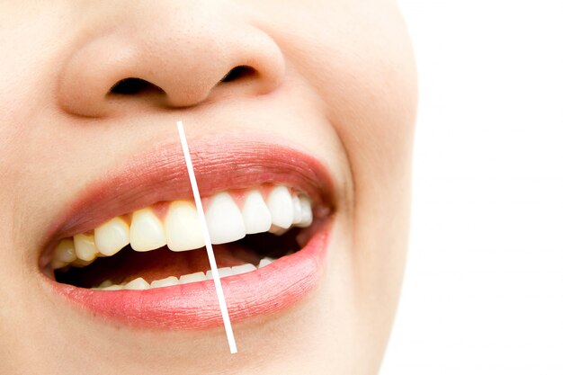 nicotine stains on teeth
