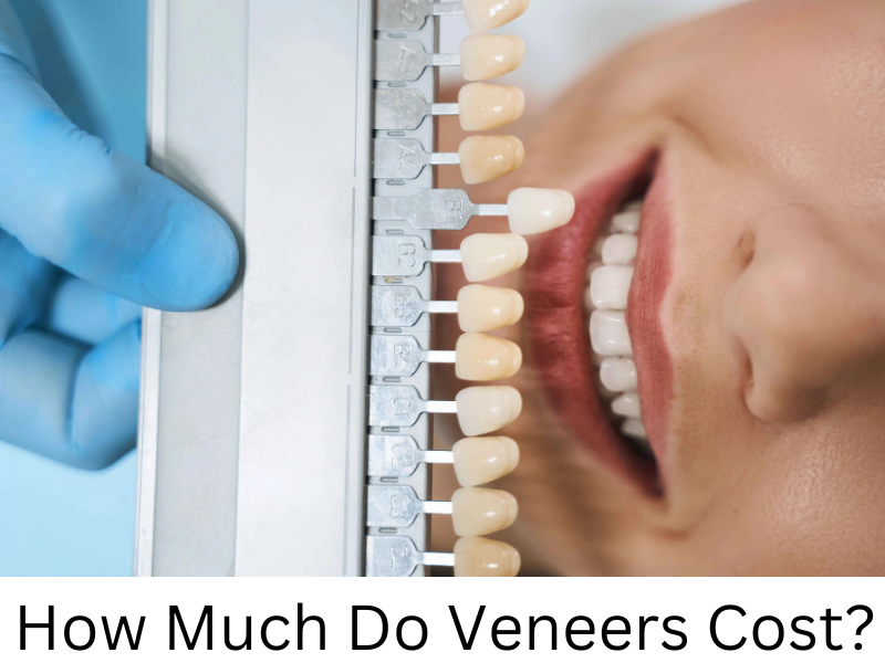 How Much Do Veneers Cost