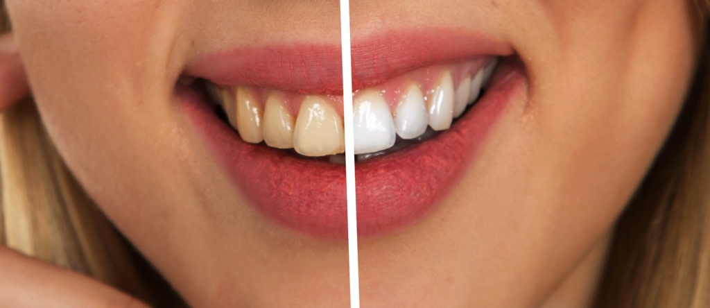 How Do Dental Stains Occur