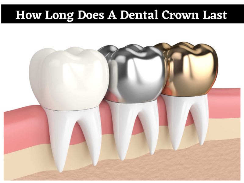 How Long Do Crowns Last?