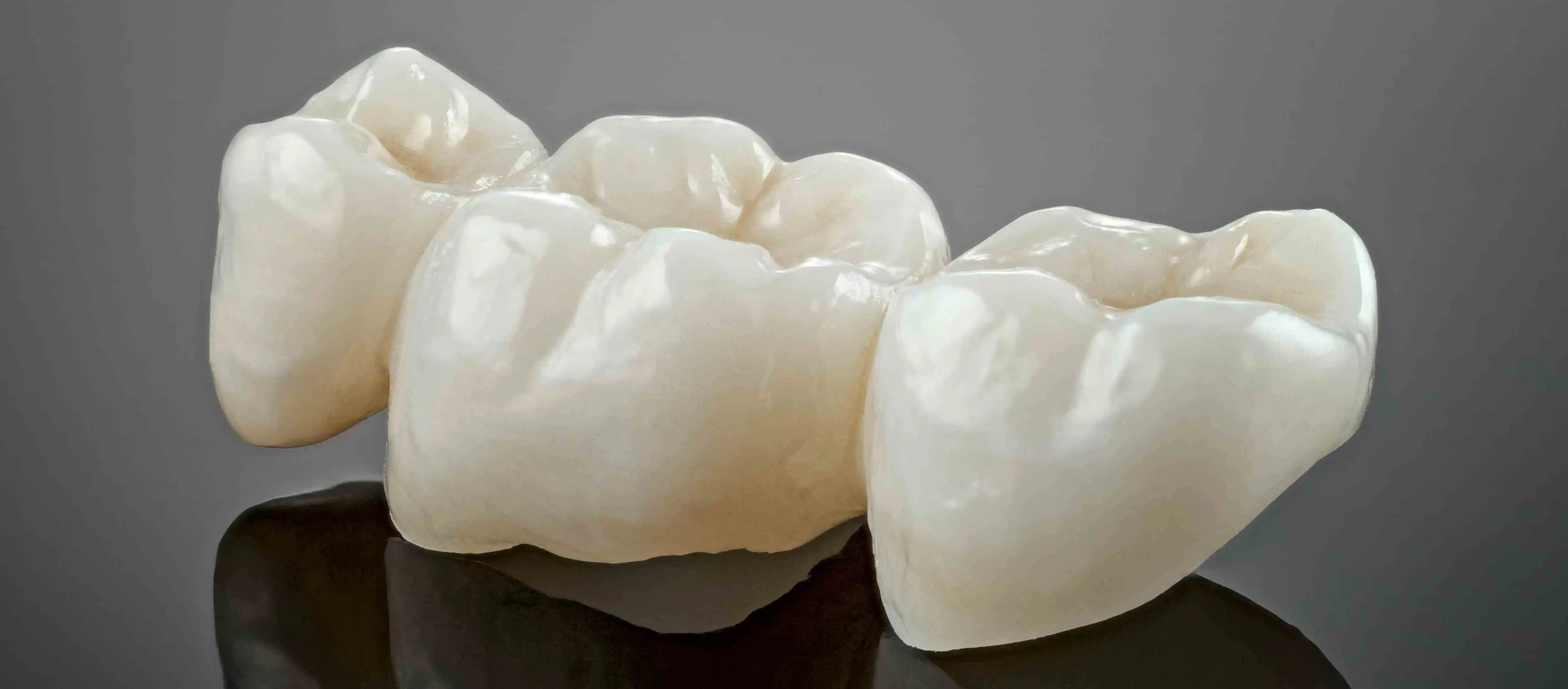 Tooth Supported Fixed Bridge