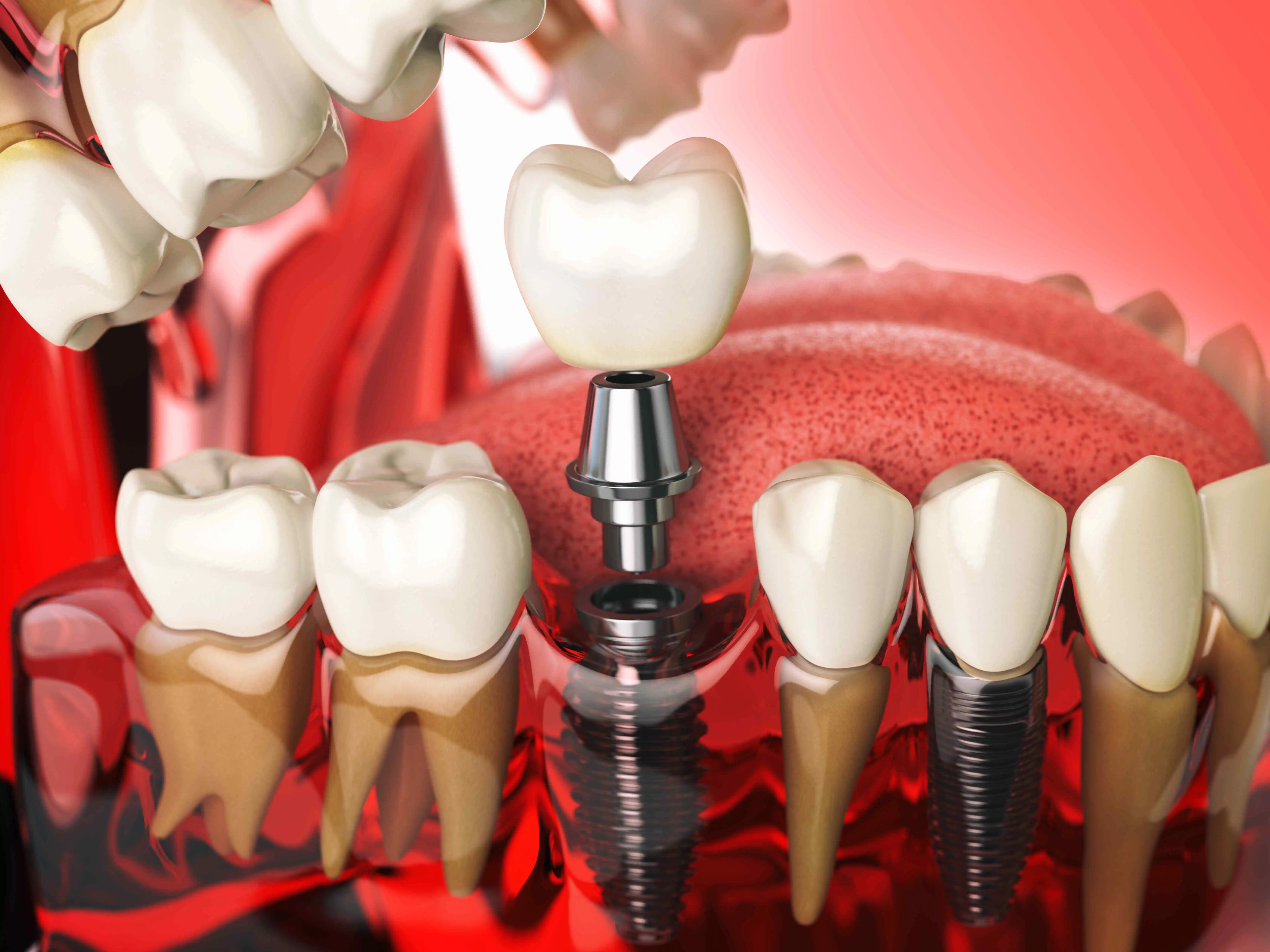 Are Dental Implants Painful
