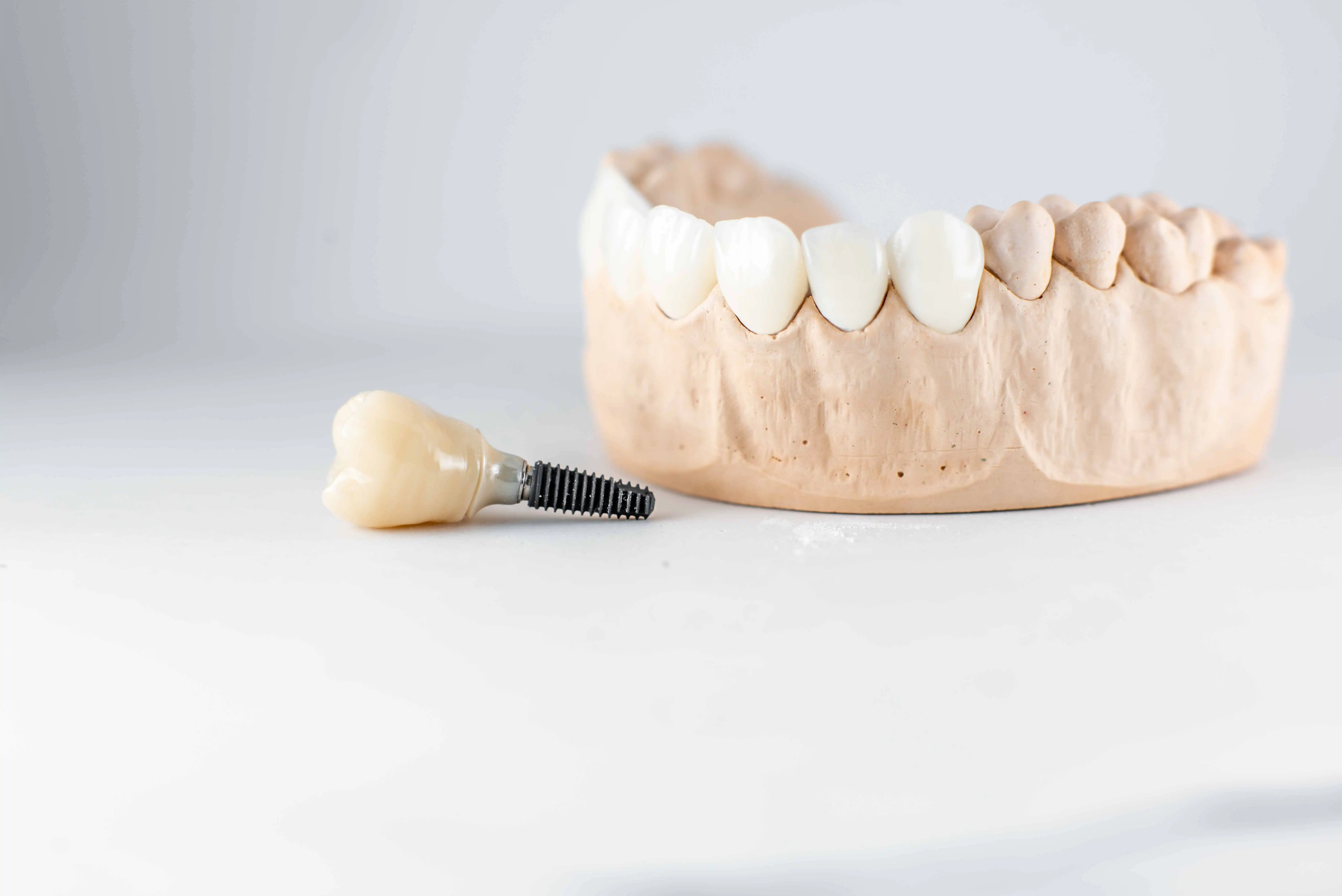 Artificial Jaw and Dental Implant