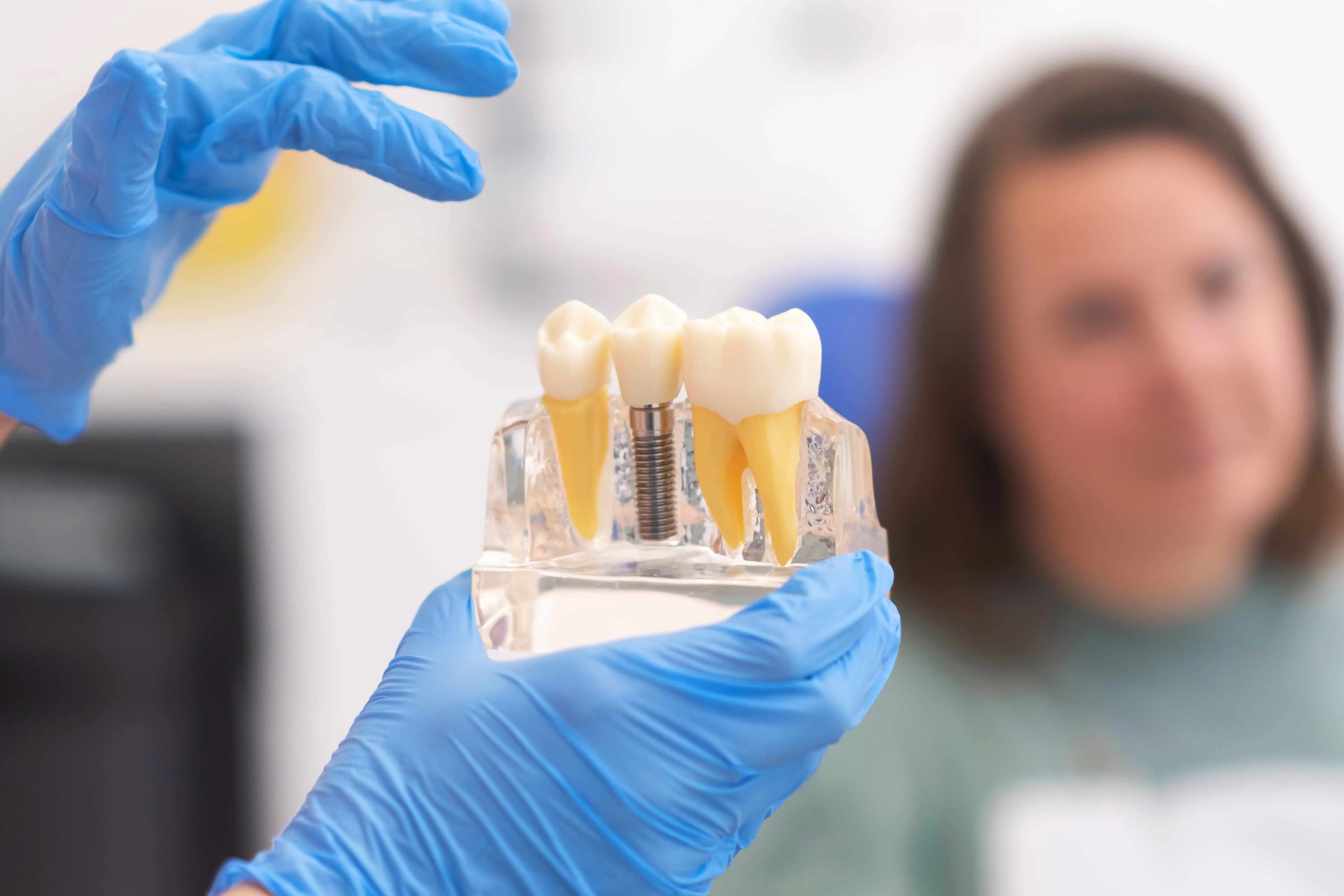 Factors Affecting the Success Rate of Dental Implants