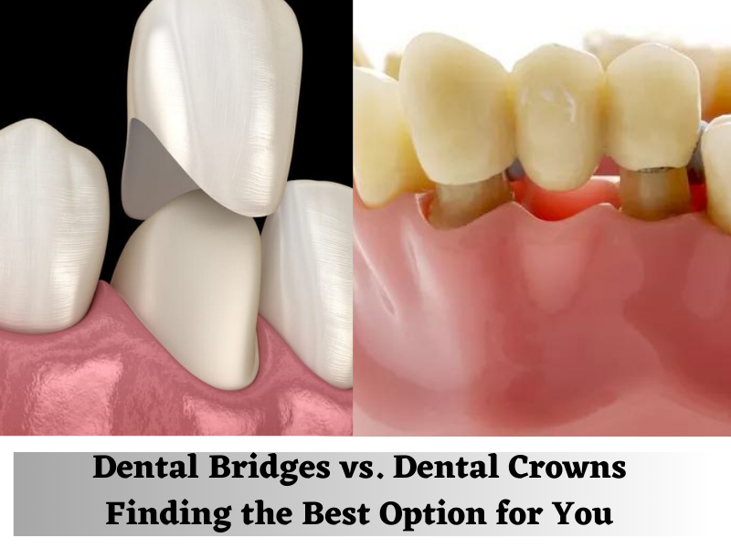 Dental Bridges vs. Dental Crowns - Finding the Best Option for You