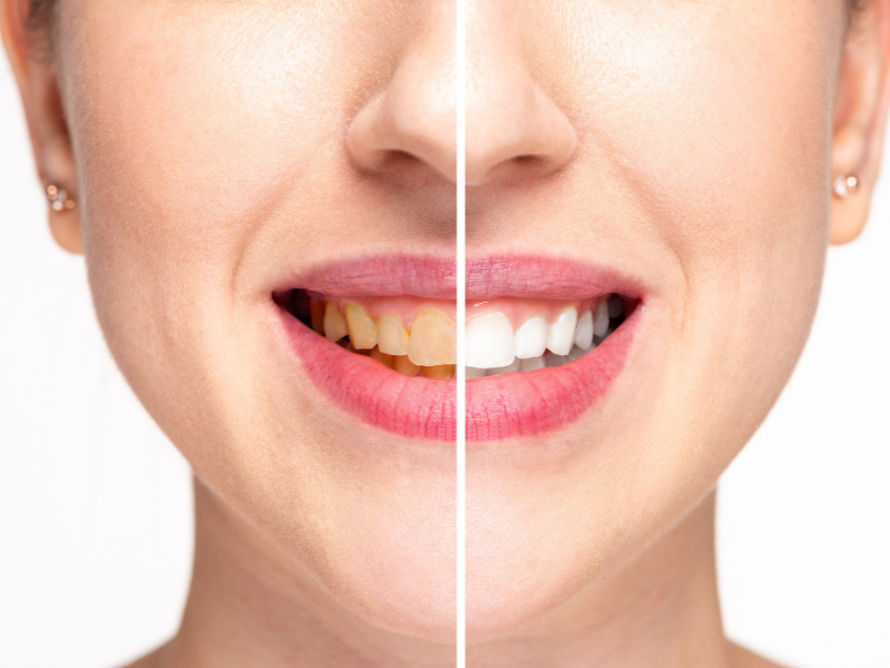 Actual Color of Healthy Teeth