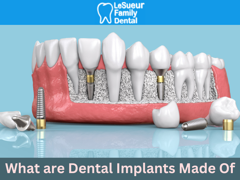 What are Dental Implants Made Of