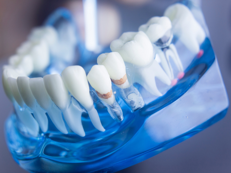 What are Dental Implants Made Of