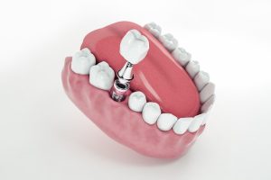 what are dental implants made of