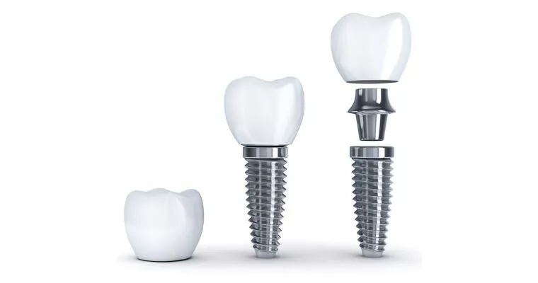 Why Are Dental Implants So Expensive