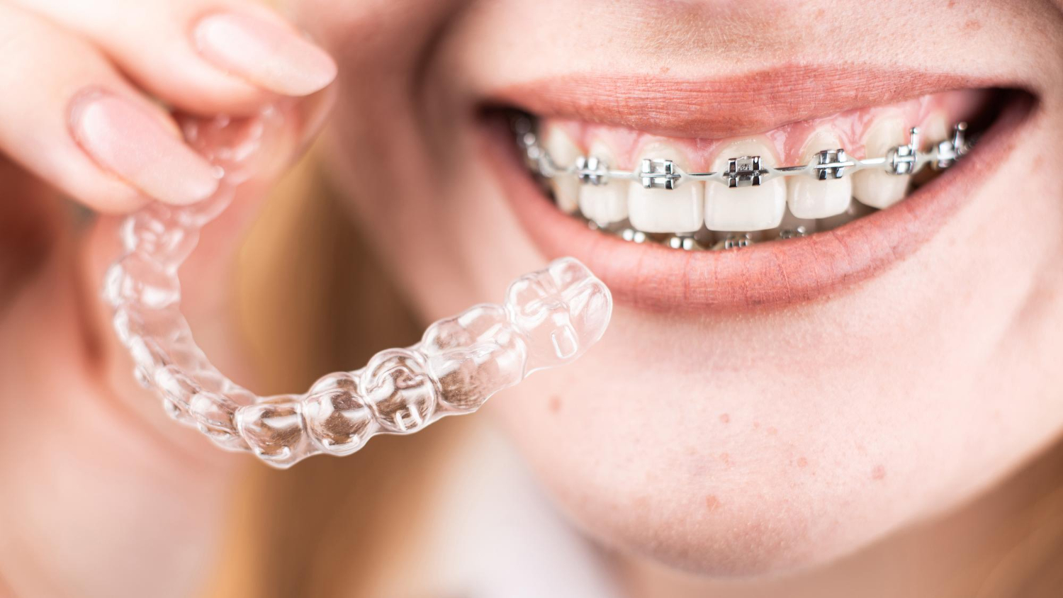 Tips for maintaining the cleanliness of your clear tooth aligners - Lesueur Family Dental