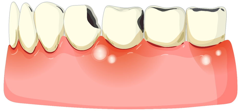 causes of tooth cavity