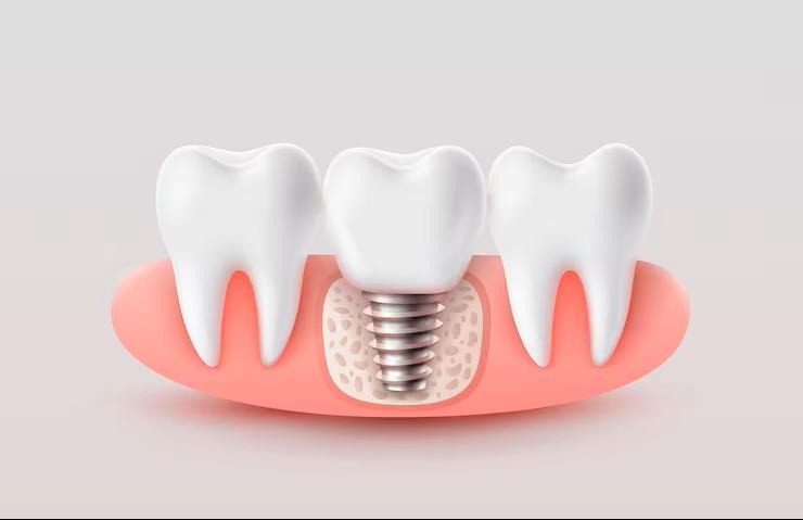 bone grafting for dental implants