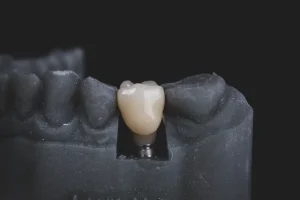 teeth cap types