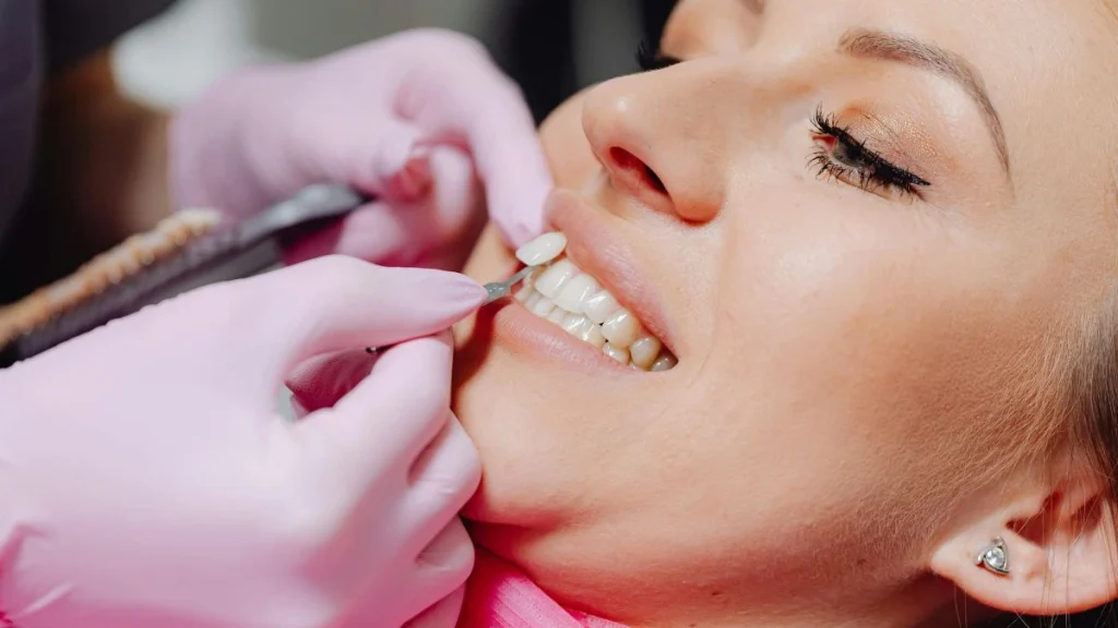 veneers before and after