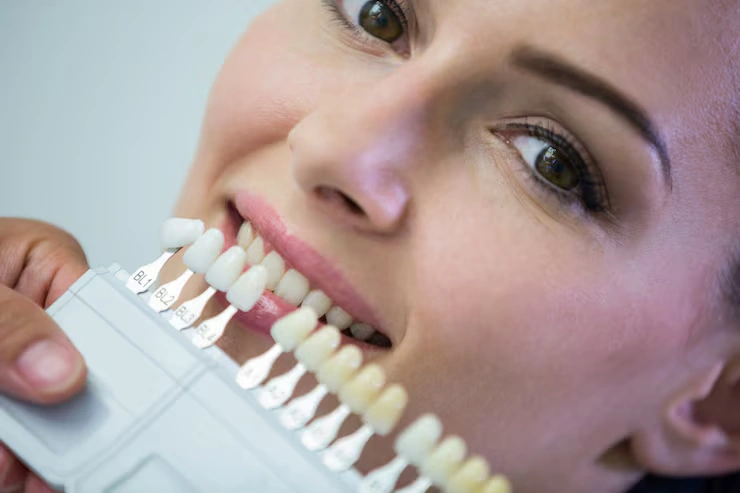 veneers for crooked teeth